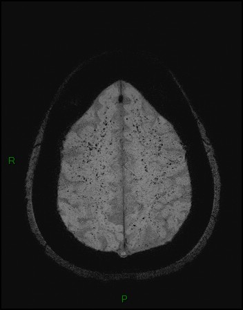 Cerebral fat embolism (Radiopaedia 35022-36525 Axial SWI 48).jpg