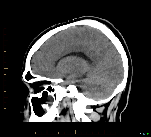 Cerebral fat embolism (Radiopaedia 85521-101220 B 23).jpg