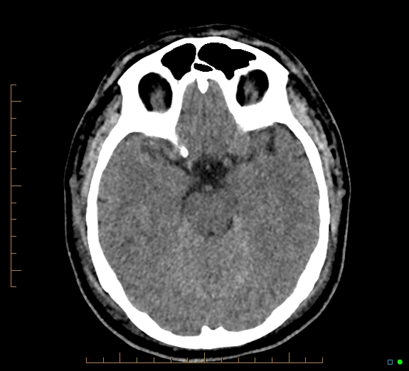Cerebral fat embolism (Radiopaedia 85521-101224 Axial non-contrast 19).jpg