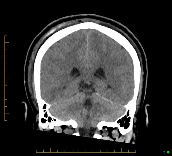 Cerebral fat embolism (Radiopaedia 85521-101224 Coronal non-contrast 42).jpg