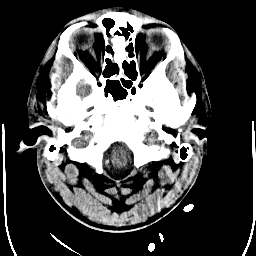 File:Cerebral hemorrhagic contusions- temporal evolution (Radiopaedia 40224-42755 AXIAL THICK 3).png