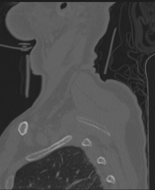 Cerebral hemorrhagic contusions and cervical spine fractures (Radiopaedia 32865-33841 Sagittal bone window 5).jpg