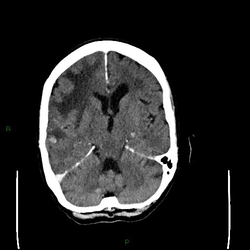 Cerebral metastases - breast primary (Radiopaedia 77653-89857 Axial C+ delayed 52).jpg