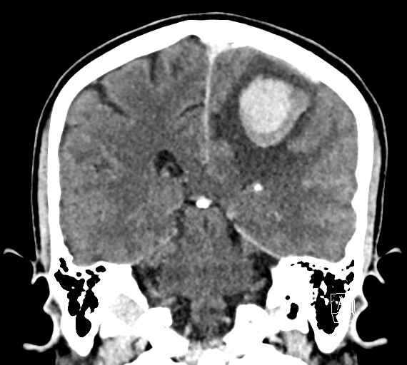Cerebral metastases - testicular choriocarcinoma (Radiopaedia 84486-99855 D 39).jpg