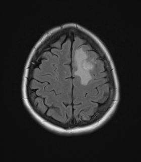 File:Cerebral metastases mimicking abscesses (Radiopaedia 45841-50131 Axial FLAIR 23).png