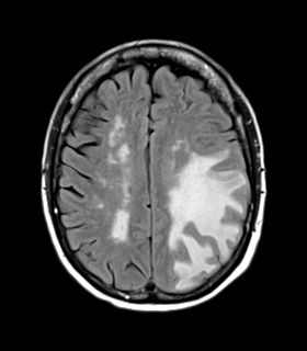 File:Cerebral metastasis (Radiopaedia 46744-51248 Axial FLAIR 19).png