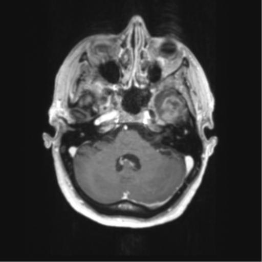 Cerebral metastasis mimicking glioblastoma (Radiopaedia 69155-78937 Axial T1 C+ 12).png