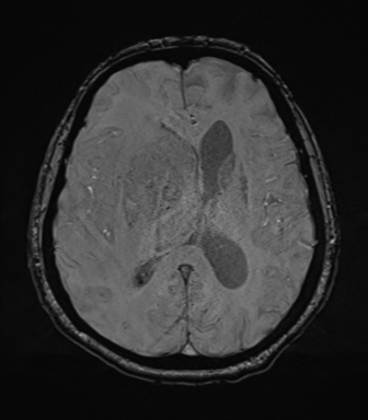 Cerebral metastasis to basal ganglia (Radiopaedia 81568-95413 Axial SWI 49).png