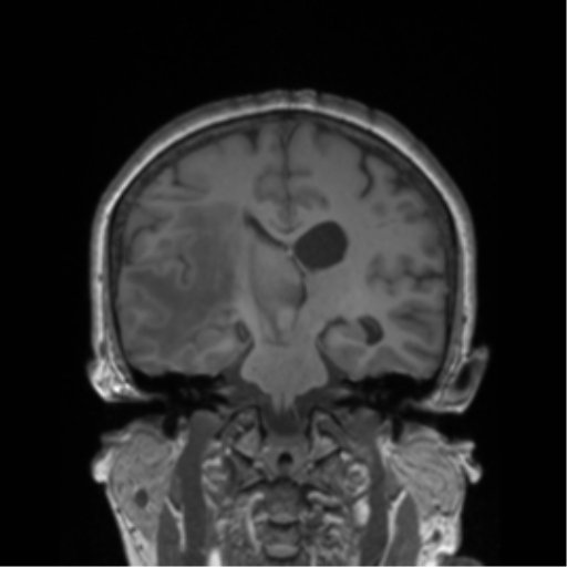 Cerebral metastasis to basal ganglia (Radiopaedia 81568-95413 Coronal T1 21).png
