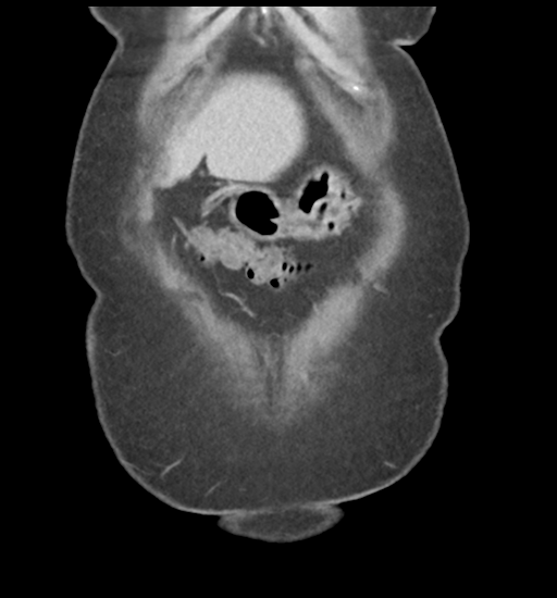 Cerebral metastasis to basal ganglia (Radiopaedia 81568-95414 F 10).png