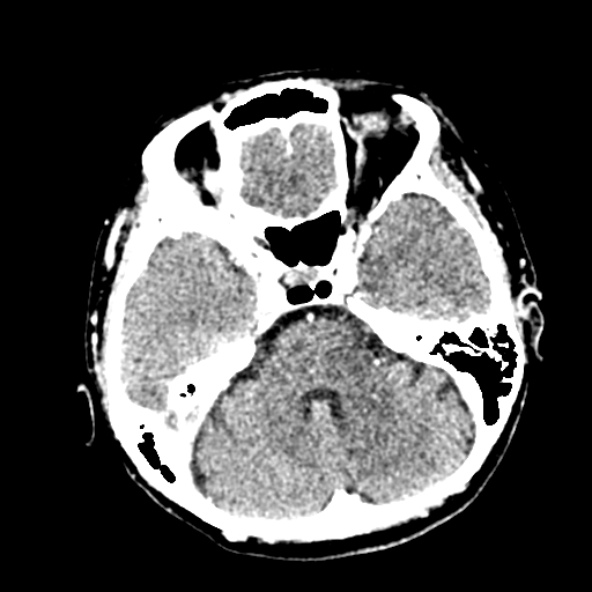 File:Cerebral ring enhancing lesions - cerebral metastases (Radiopaedia 44922-48818 B 89).jpg