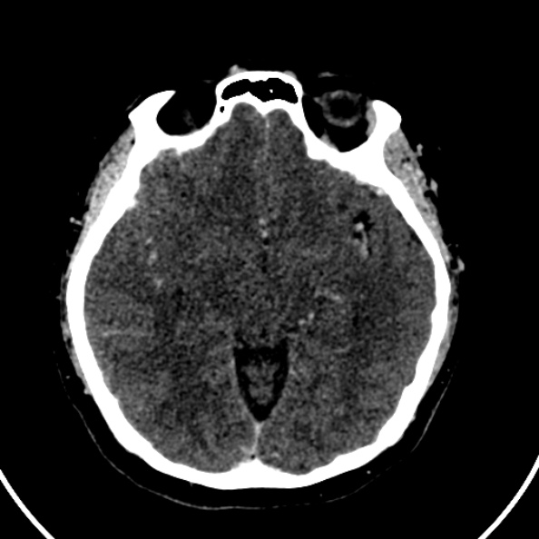 File:Cerebral venous hemorrhagic infarct from venous sinus thrombosis (Radiopaedia 55433-61883 Axial C+ delayed 87).jpg