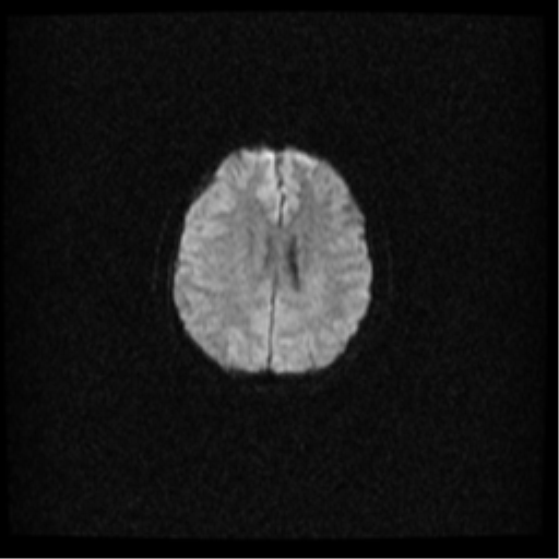 Cerebral venous hemorrhagic infarction (Radiopaedia 38461-40552 Axial DWI 25).png
