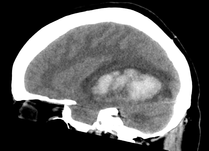 File:Cerebral venous infarct related to dural venous sinus thromboses (Radiopaedia 35292-36803 Sagittal 21).png