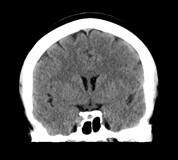 File:Cerebral venous infarct related to dural venous sinus thromboses (Radiopaedia 35292-36804 Coronal non-contrast 16).png