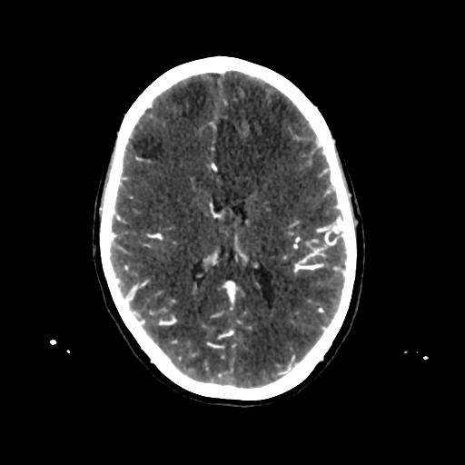 File:Cerebral venous throbmosis - hemorrhagic venous infarction (Radiopaedia 87318-103613 Axial CT venogram 20).jpg