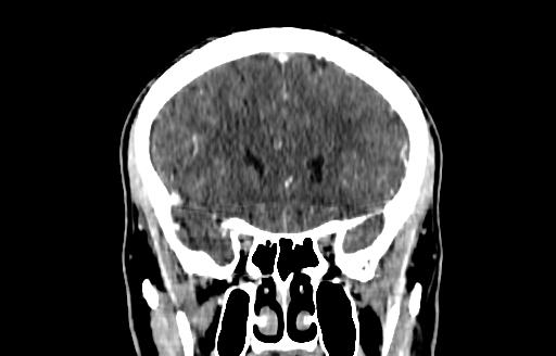 Cerebral venous thrombosis (CVT) (Radiopaedia 77524-89685 C 19).jpg