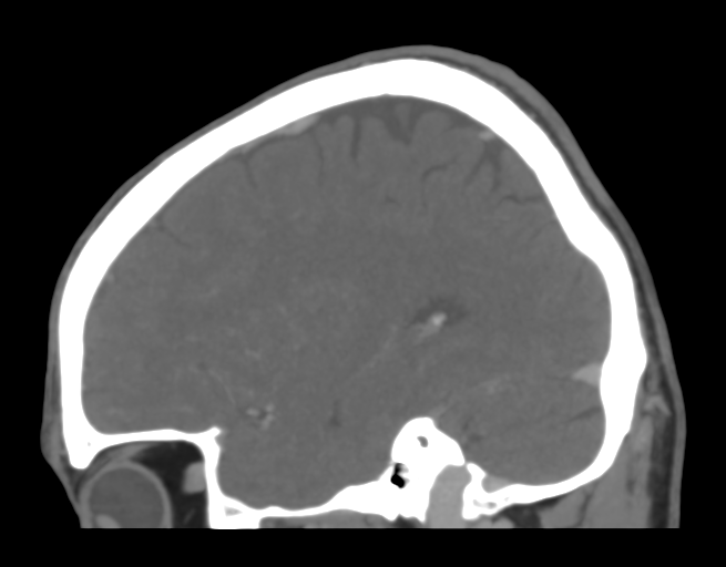 File:Cerebral venous thrombosis (Radiopaedia 38392-40467 D 38).png