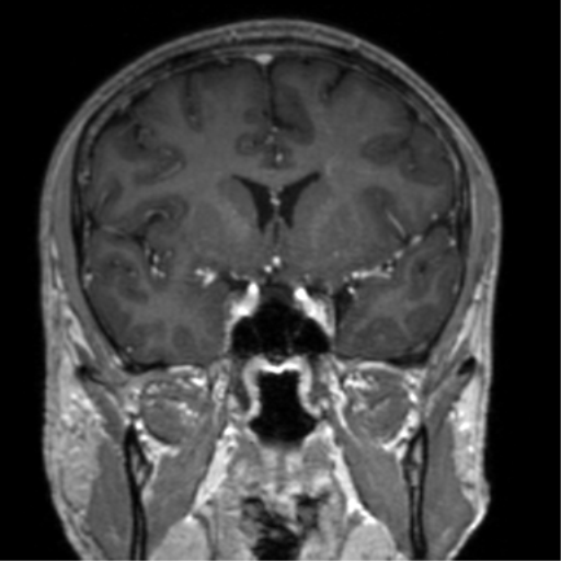Cerebral venous thrombosis (Radiopaedia 38392-40469 Coronal T1 C+ 55).png