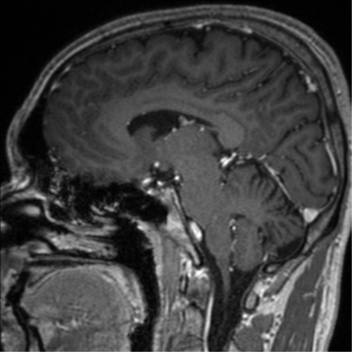 Cerebral venous thrombosis (Radiopaedia 38392-40469 Sagittal T1 C+ 42).png