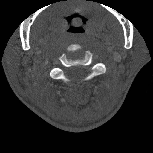 Cervical Pott disease (Radiopaedia 20374-20286 Axial bone window 47).jpg