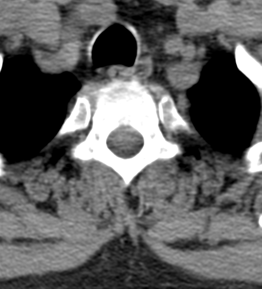File:Cervical canal stenosis - OPLL and osteophytes (Radiopaedia 47329-51910 Axial non-contrast 59).png