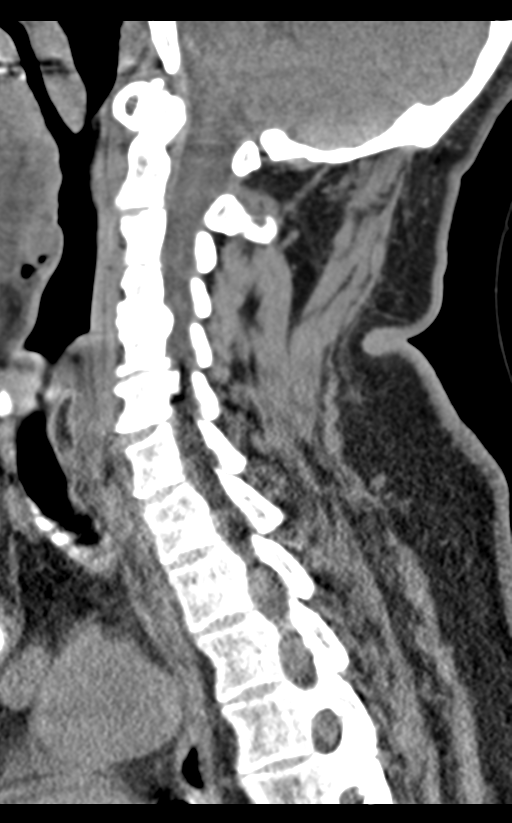 Cervical canal stenosis - OPLL and osteophytes (Radiopaedia 47329-51910 B 35).png