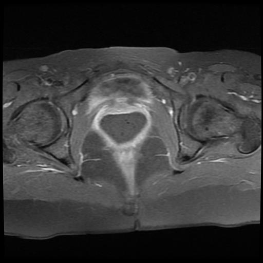 File:Cervical cancer (Radiopaedia 62991-71413 Axial T1 C+ fat sat 15).jpg