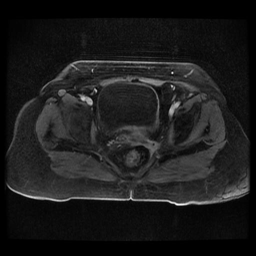 Cervical carcinoma (Radiopaedia 70924-81132 Axial T1 C+ fat sat 136).jpg