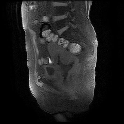 File:Cervical carcinoma (Radiopaedia 78847-91705 Sagittal T1 fat sat 7).jpg