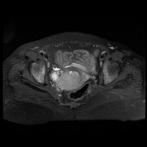 File:Cervical carcinoma (Radiopaedia 88010-104555 Axial T2 fat sat 12).jpg