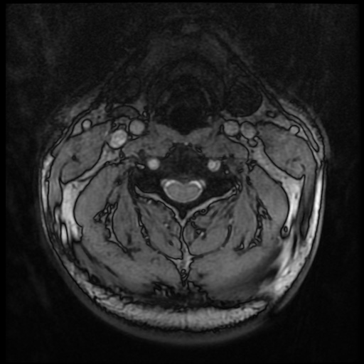 Cervical disc extrusion (Radiopaedia 59074-66364 G 31).jpg