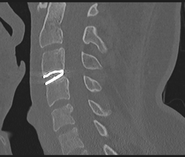 Cervical disc replacement (Radiopaedia 44025-47541 Sagittal bone window 43).png