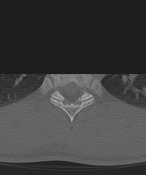 Cervical intercalary bone (Radiopaedia 35211-36748 Axial bone window 93).png