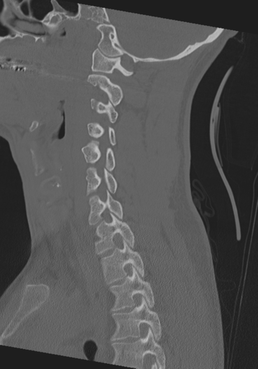 Cervical intercalary bone (Radiopaedia 35211-36748 Sagittal bone window 31).png