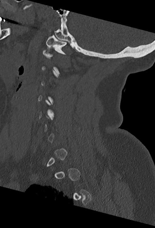 Cervical spine ACDF loosening (Radiopaedia 48998-54070 Sagittal bone window 28).png
