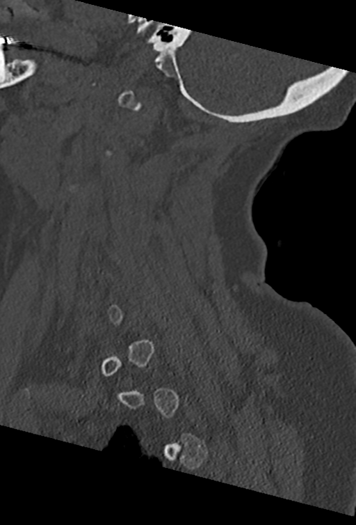 Cervical spine ACDF loosening (Radiopaedia 48998-54070 Sagittal bone window 64).png