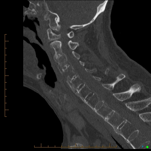 Cervical spine fracture - ankylosing spondylitis (Radiopaedia 76835-88706 Sagittal bone window 50).jpg