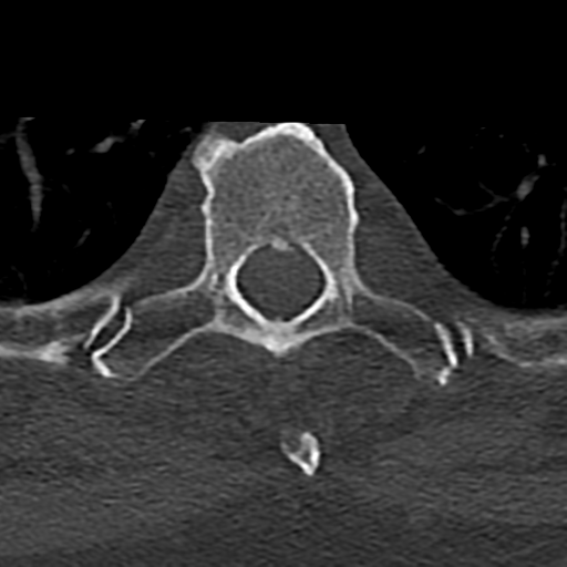 Cervical spine fracture - chalk stick (Radiopaedia 39116-41323 Axial bone window 105).png