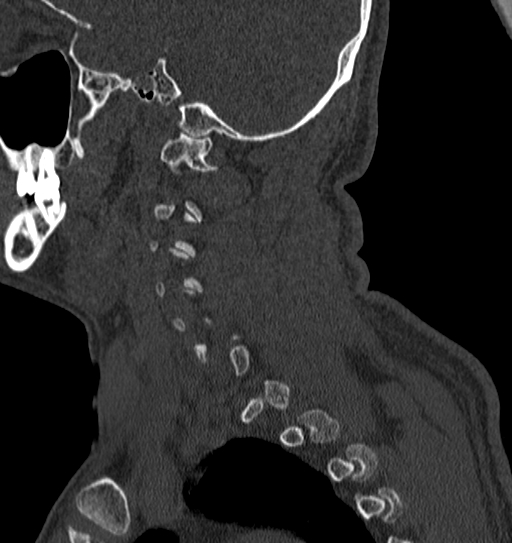 Cervical spine trauma with tear drop fracture and perched facet joint (Radiopaedia 53989-60127 Sagittal bone window 144).jpg