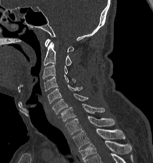 Cervical spine trauma with tear drop fracture and perched facet joint (Radiopaedia 53989-60127 Sagittal bone window 75).jpg