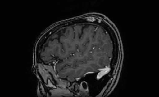 File:Cervical spondylodiscitis and calvarial hemangioma (Radiopaedia 64317-73103 Sagittal T1 C+ 11).jpg