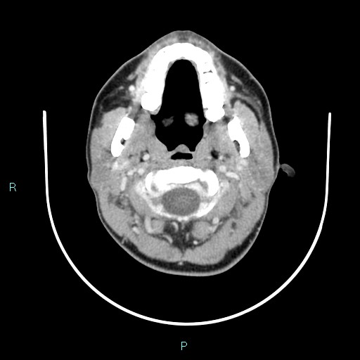 Cervical thymic cyst (Radiopaedia 88632-105335 C 91).jpg