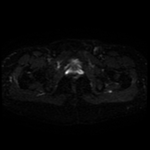 Cesarian section scar endometriosis (Radiopaedia 66520-75799 Axial DWI 22).jpg