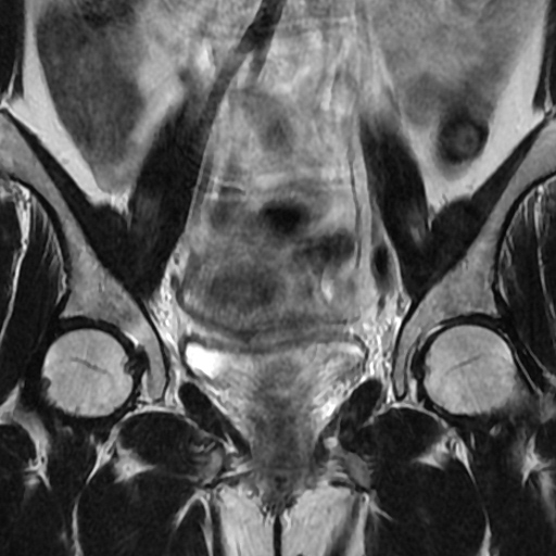 File:Cesarian section scar endometriosis (Radiopaedia 66520-75799 Coronal T2 16).jpg