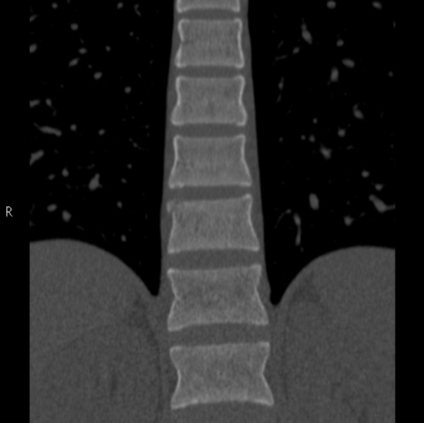 File:Chance fracture (Radiopaedia 36521-38081 Coronal bone window 23).jpg