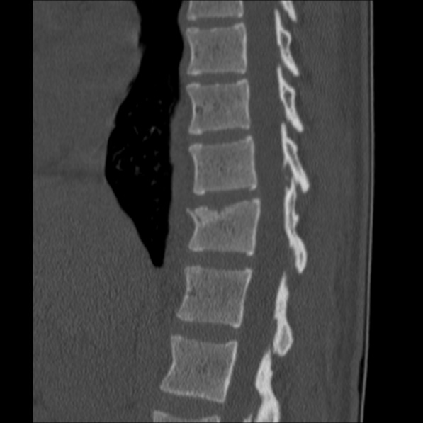 Chance fracture (Radiopaedia 36521-38081 Sagittal bone window 25).jpg