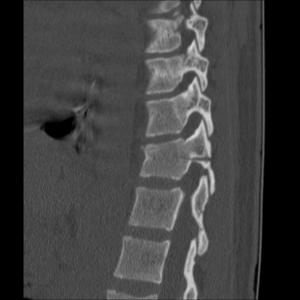Chance fracture (Radiopaedia 36521-38081 Sagittal bone window 46).jpg