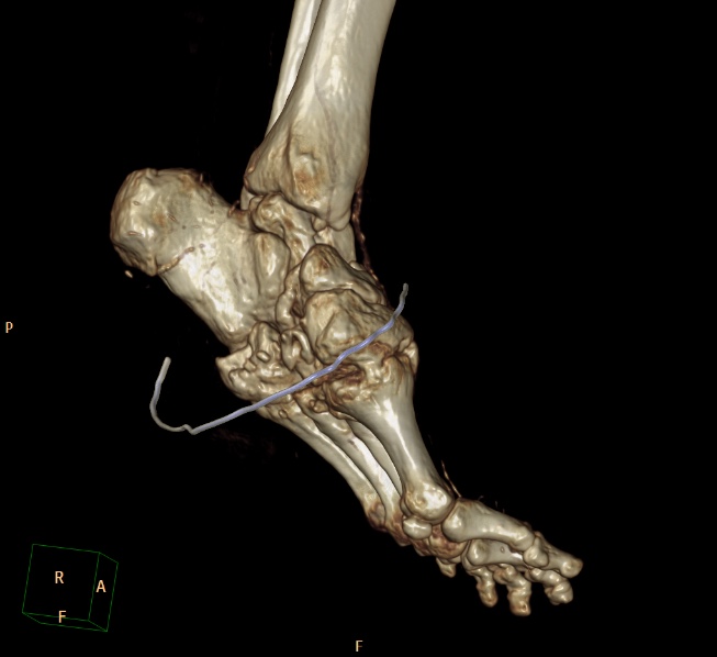File:Charcot joint (Radiopaedia 36629-38194 3D bone window 5).jpg