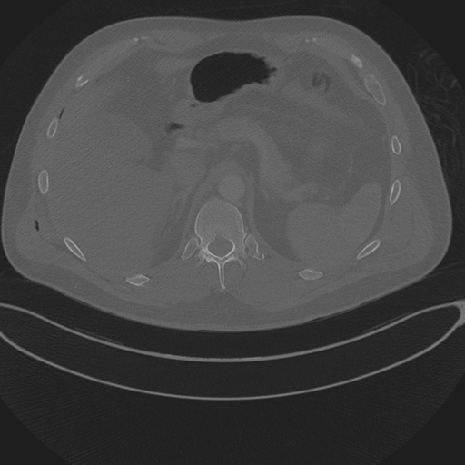 Chest multitrauma - aortic injury (Radiopaedia 34708-36147 Axial bone window 294).png
